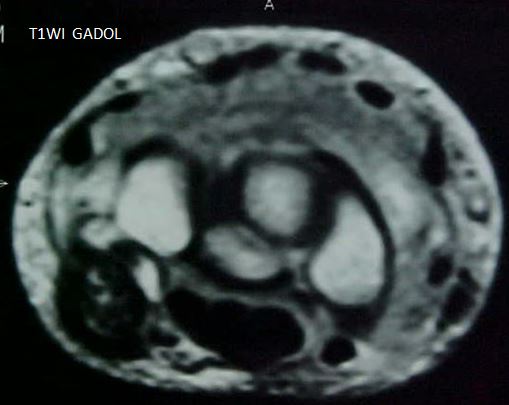 Figure 5 for case Psoriatic arthritis on the wrist